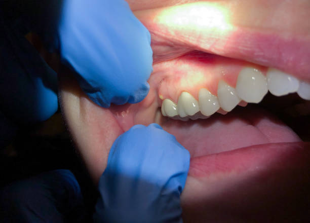 Best Emergency Dental Care for Abscessed Tooth in Arial, SC