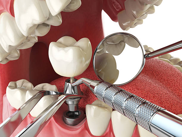 Best Emergency Dental Extractions in Arial, SC